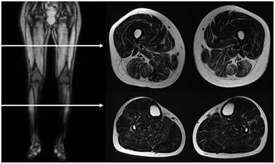 A Muscle Biosignature Differentiating Between Limb-Girdle Muscular Dystrophy and Idiopathic Inflammatory Myopathy on Magnetic Resonance Imaging